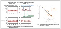 Successful Extraction of Alzheimer's-type Dementia Finger-tapping Pattern