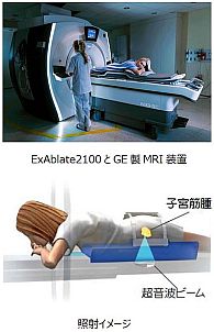 GEヘルスケア、インサイテック社との共同開発―MRガイド下集束超音波治療器の新製品「ExAblate2100」を日本市場へ投入